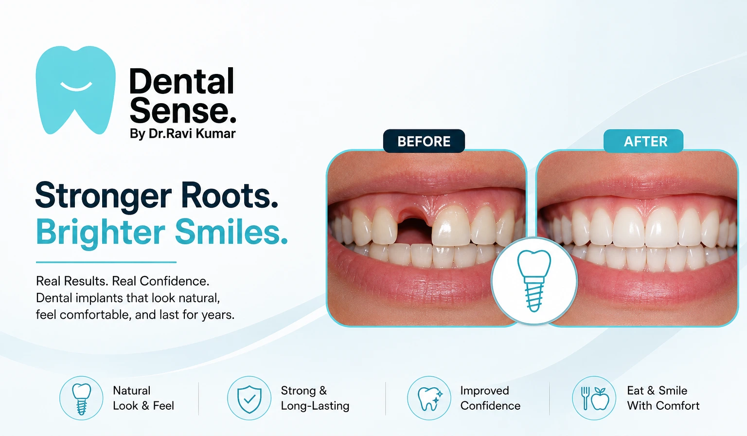 Dental implants before and after results in Patna at Dental Sense