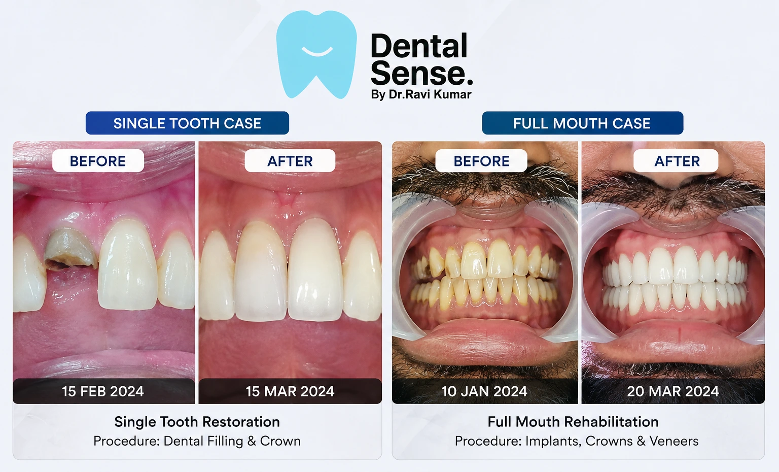 Single tooth dental implant before and after in Patna